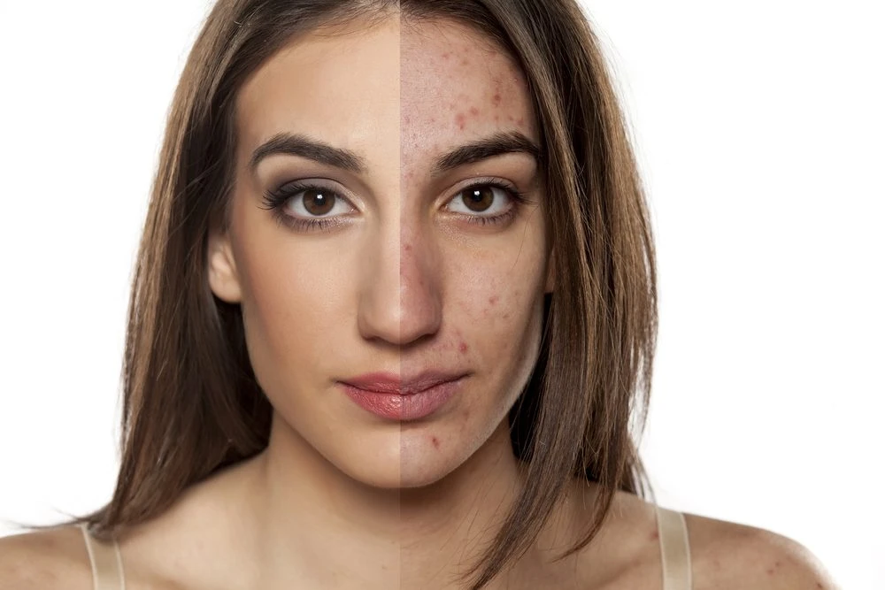7 Common Paleo Mistakes that Cause Acne